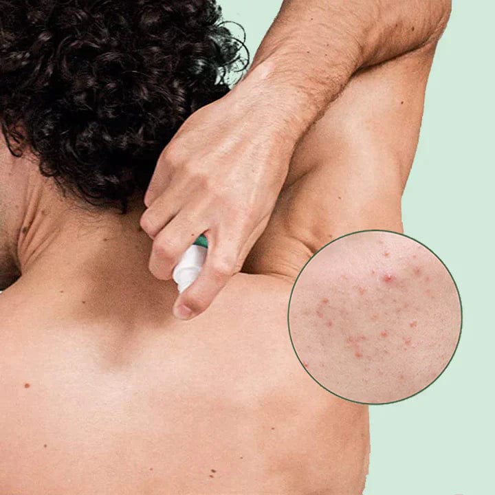 1 MEDix™ Back Acne Treatment Spray Roposo Clout