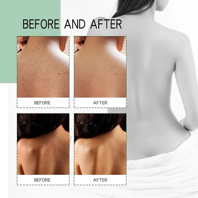 1 MEDix™ Back Acne Treatment Spray Roposo Clout