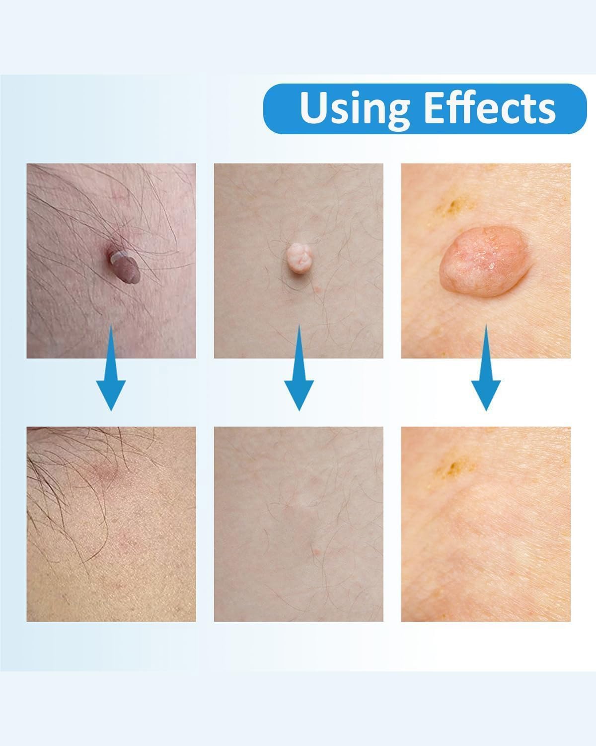 Skin Tag Remover Kit