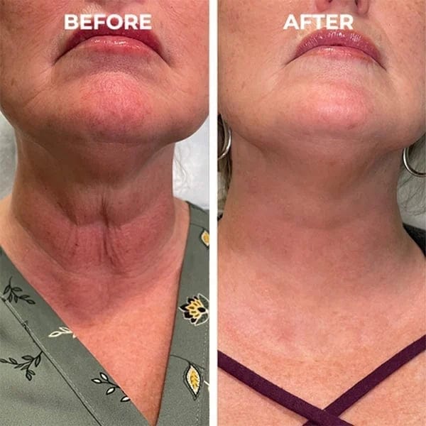 Botox Antiage Face Serum Zaavio®