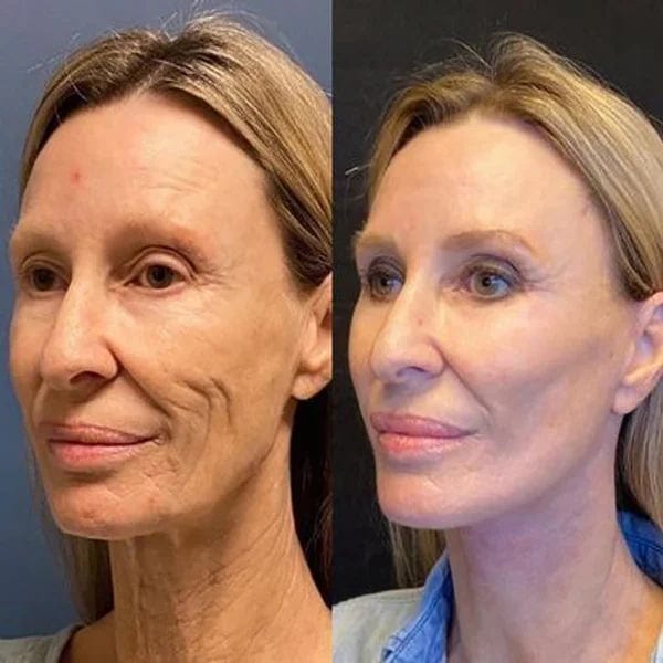 Botox Antiage Face Serum Zaavio®