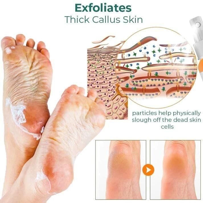 Foot Callus Removal Spray(Pack Of 2) Zaavio®