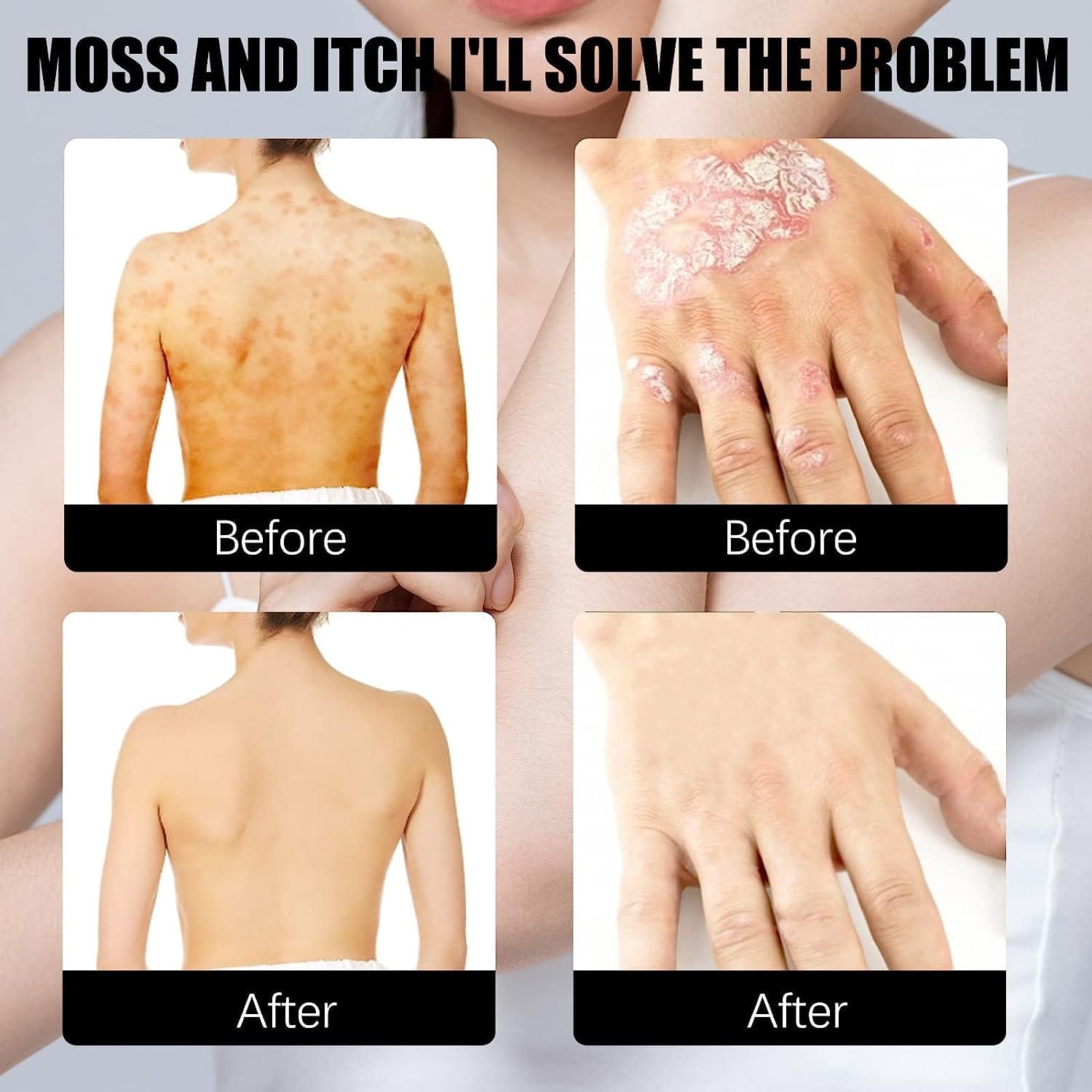 Herbal Psoriasis Relief Spray Roposo Clout