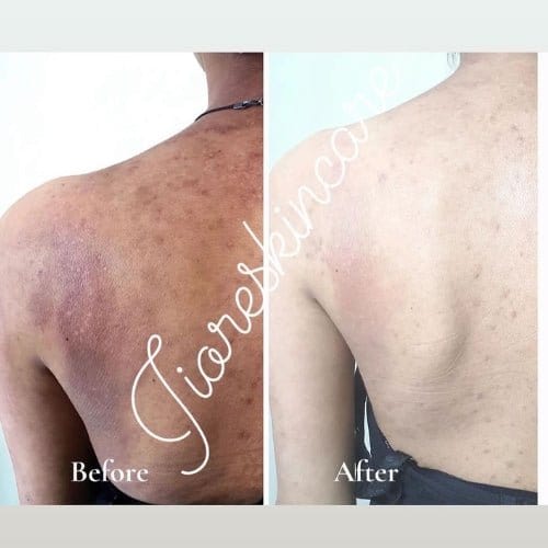 Kojic Body Soap (Buy 1 Get 2) | Skin Whitening Soap Dark Spots On Skin Tone Kojic Soap Whitening Kojic Body Soap (Buy 1 Get 2) Zaavio®