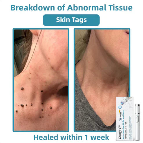 Non-Invasive Mole and Wart Removal Laser Pen
