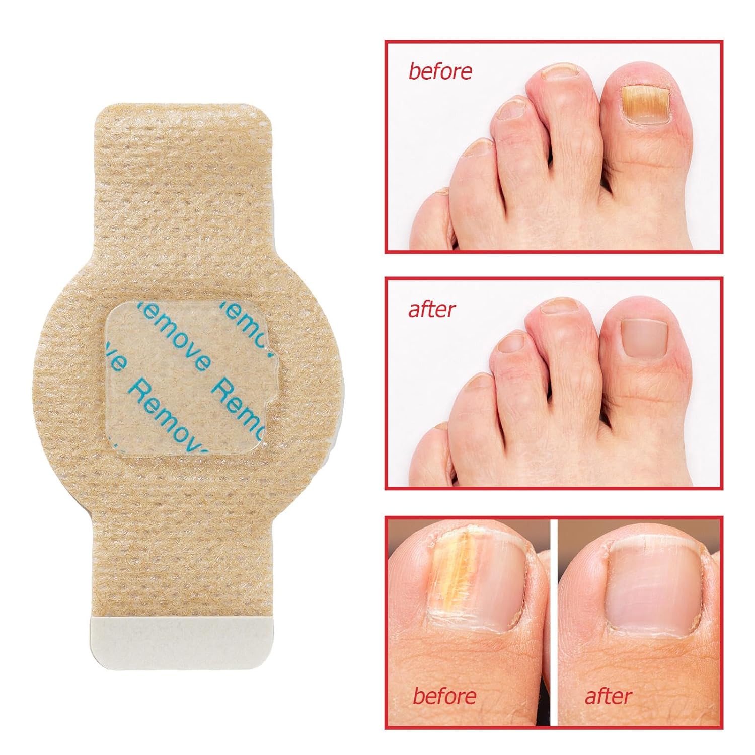 Fungal Nail Patches (Pack of 2)