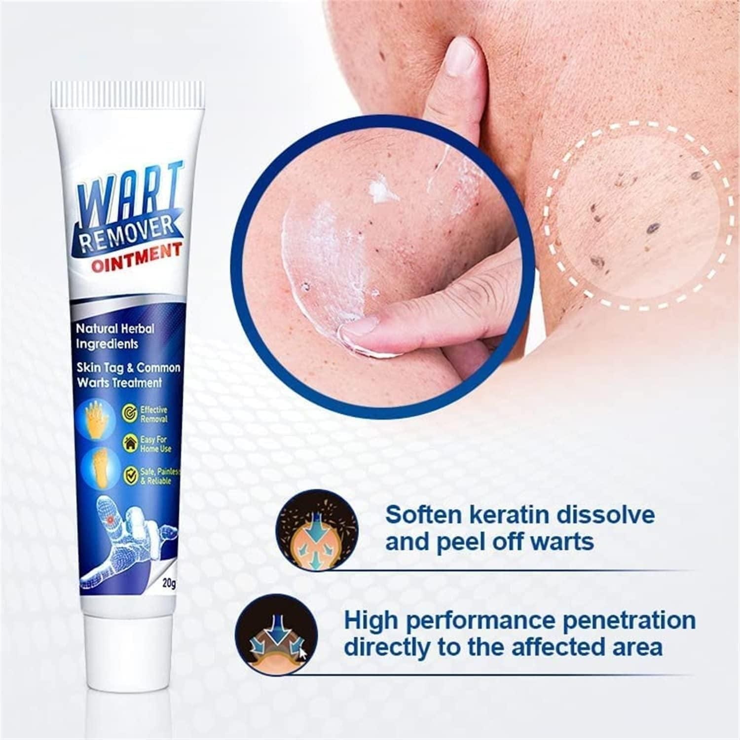 ointment 100g Warts Off Instant Blemish Removal Cream Wart Remover Ointment for All Skin Types (Pack of 1) Roposo Clout