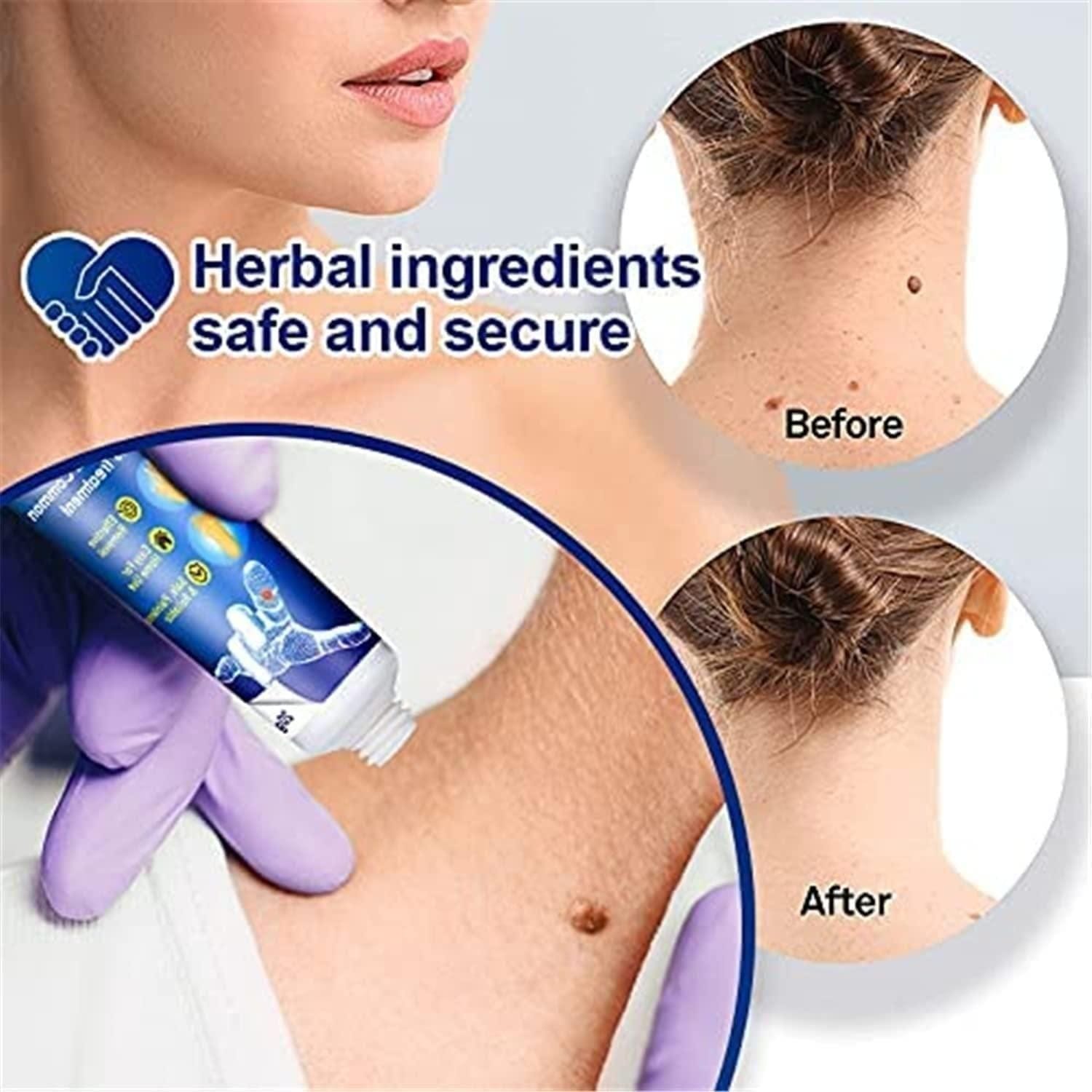 ointment 100g Warts Off Instant Blemish Removal Cream Wart Remover Ointment for All Skin Types (Pack of 1) Roposo Clout