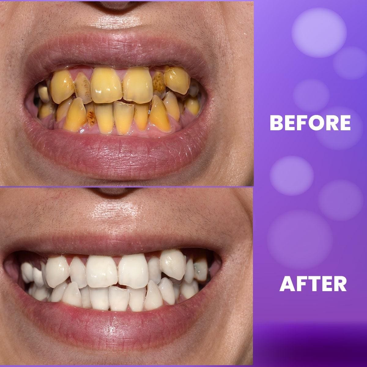 Purple Teeth Whitening Gel (Copy) Zaavio®