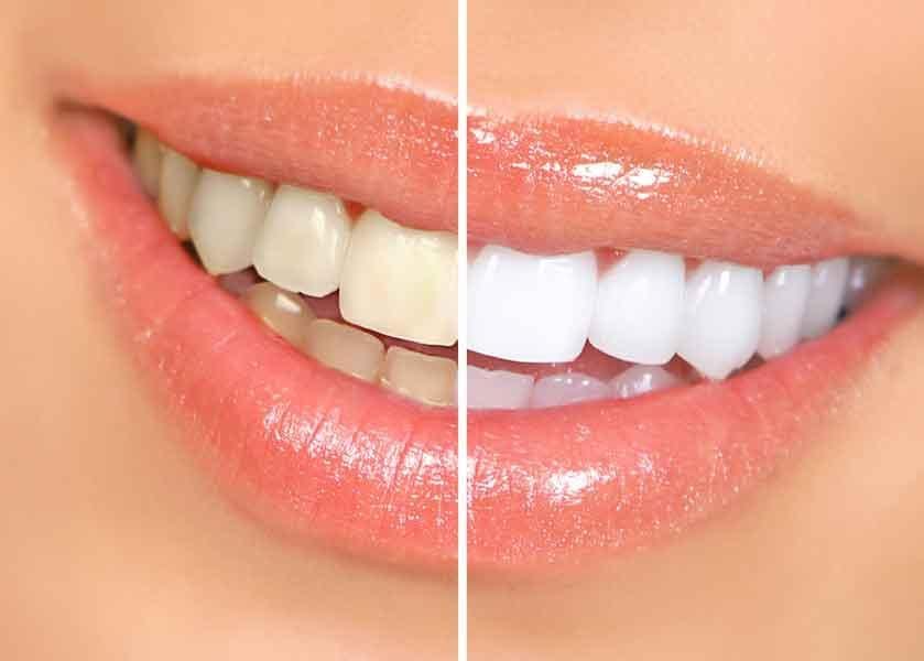 Purple Teeth Whitening Gel Zaavio®