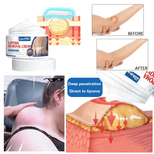 Removel Cream Herbal Lipoma Removal Cream WowSmart