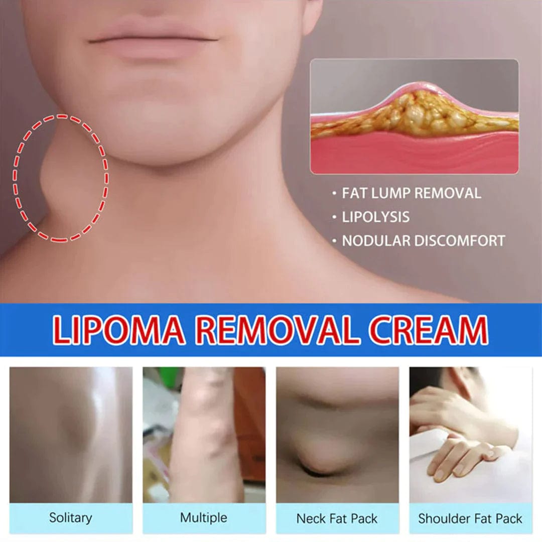 Removel Cream Herbal Lipoma Removal Cream WowSmart