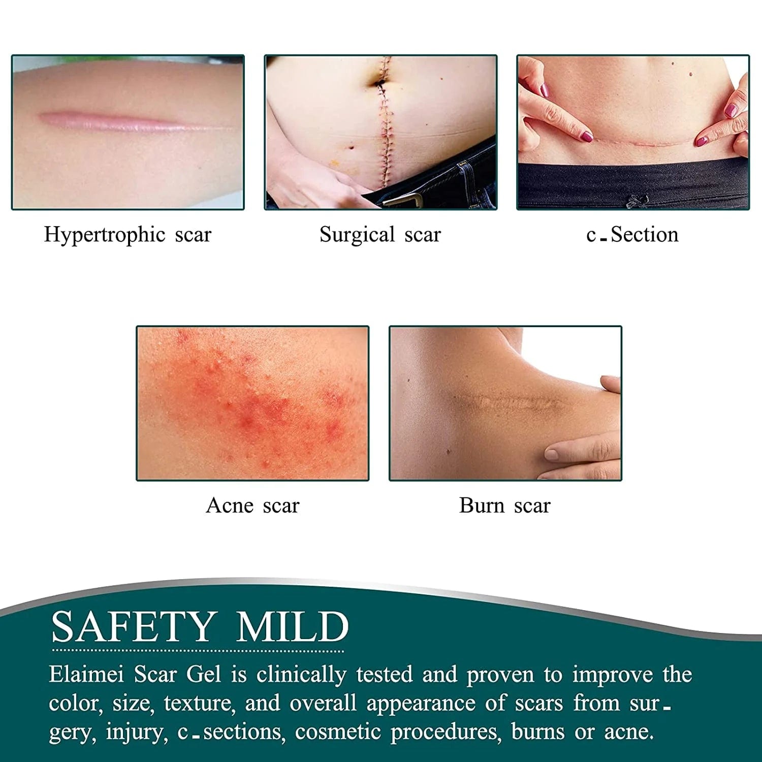 Silicone Gel Scar Removal Sheets Silicone Tape Strips For Scars - Dermoxy™️ Health Dermoxy™️ Zaavio®️