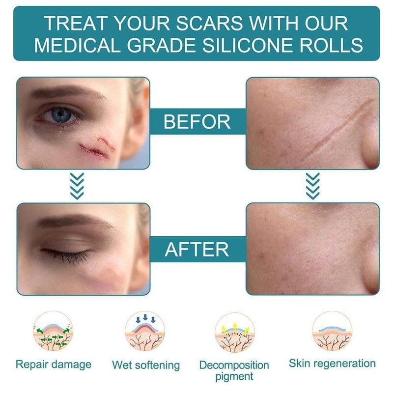 Silicone Gel Scar Removal Sheets Silicone Tape Strips For Scars - Dermoxy™️ Health Dermoxy™️ Zaavio®️