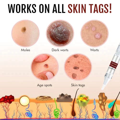 Tags & Moles Remover Avanta
