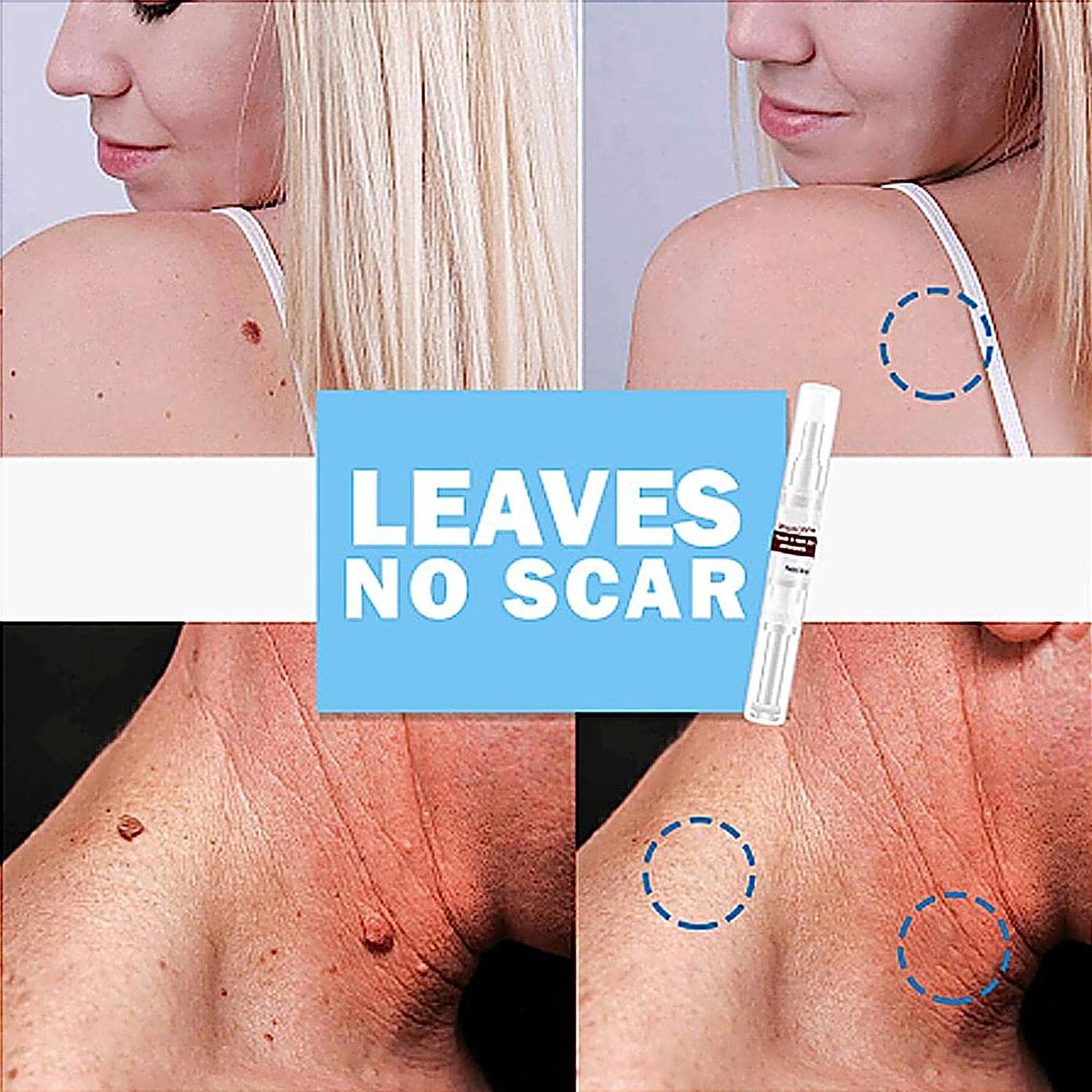 Tags & Moles Remover Zaavio®