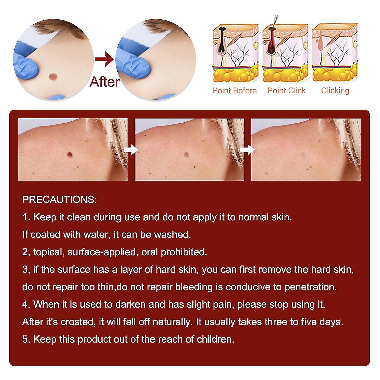 Tags & Moles Remover Zaavio®