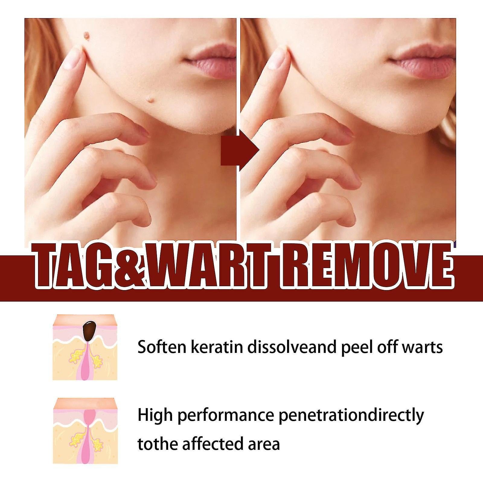 Tags & Moles Remover Zaavio®