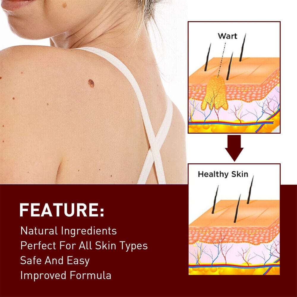 Tags & Moles Remover Zaavio®