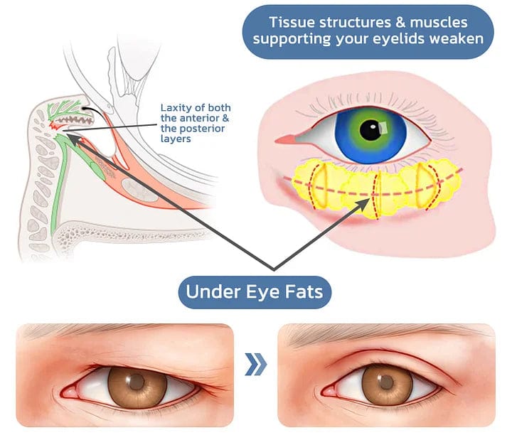 UnderEye Gel (50% OFF) Zaavio®
