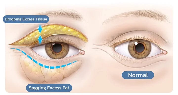 UnderEye Gel (50% OFF) Zaavio®
