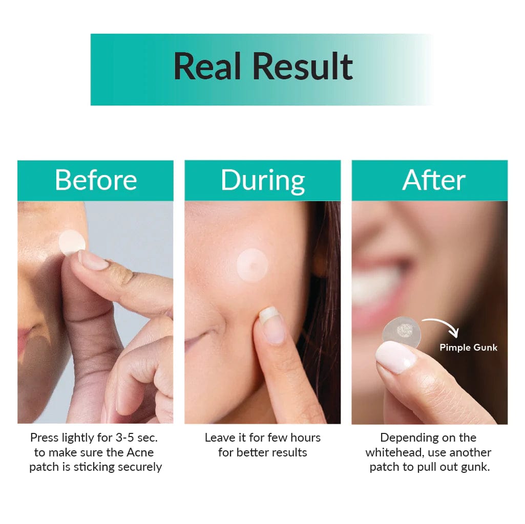 Pimple Patch Zaavio®