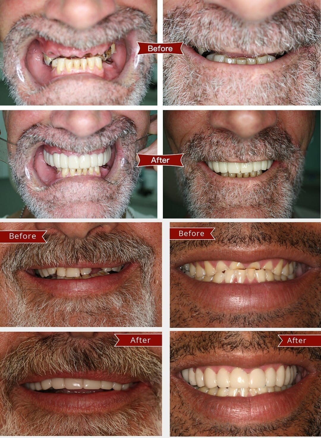 tool Adjustable Snap On Dentures fashionjun