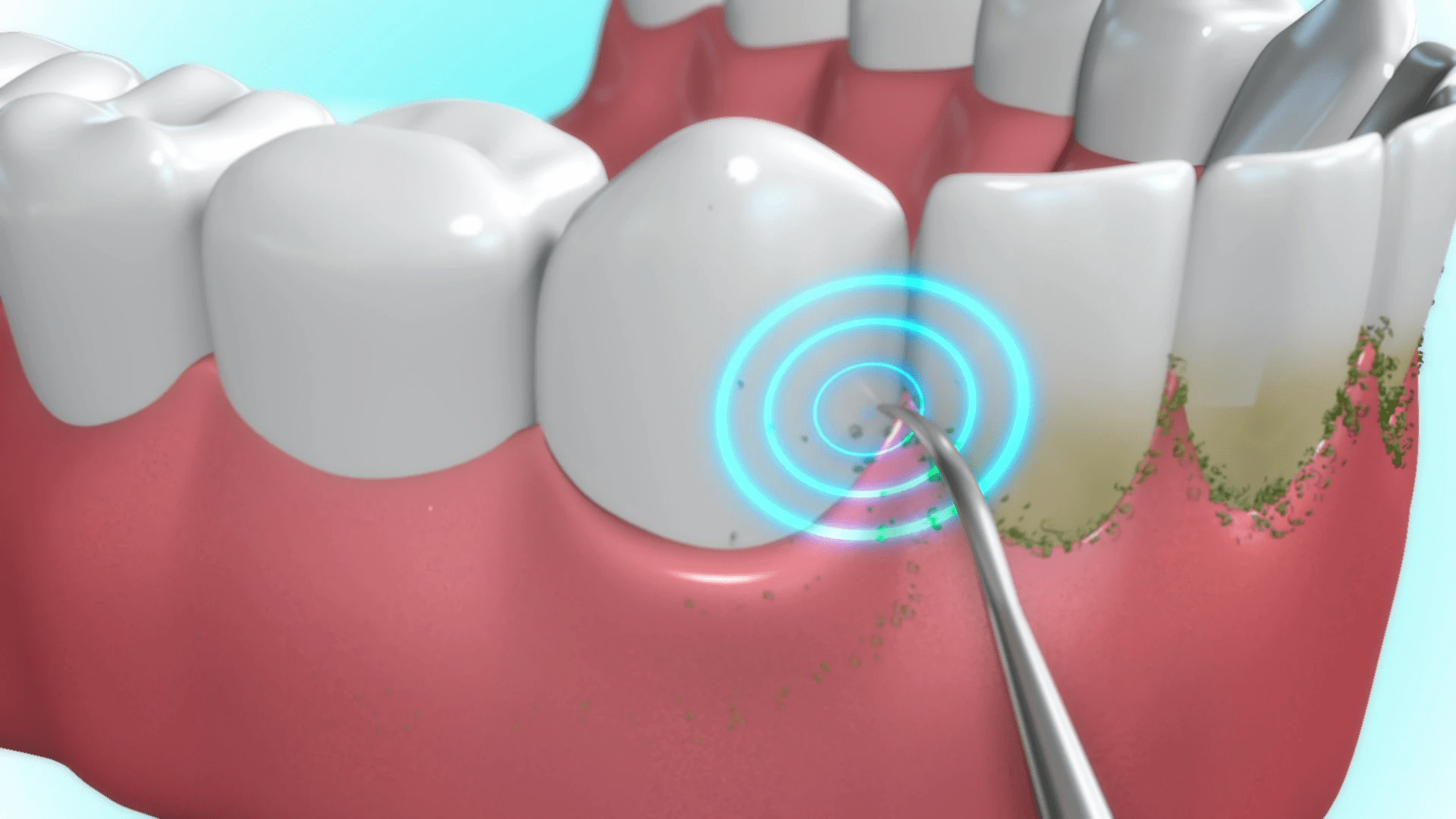 Ultrasonic Scalar Tooth Cleaner at Home Teeth Stain Remover Machine - Dentidy™ Teeth Whitening Dentidy™ Zaavio®