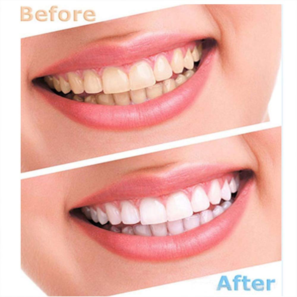 Best Teeth Whitening Polisher Stain Reomover Home Kit  - Dentelio™ Teeth Whitening Dentelio™ Zaavio®