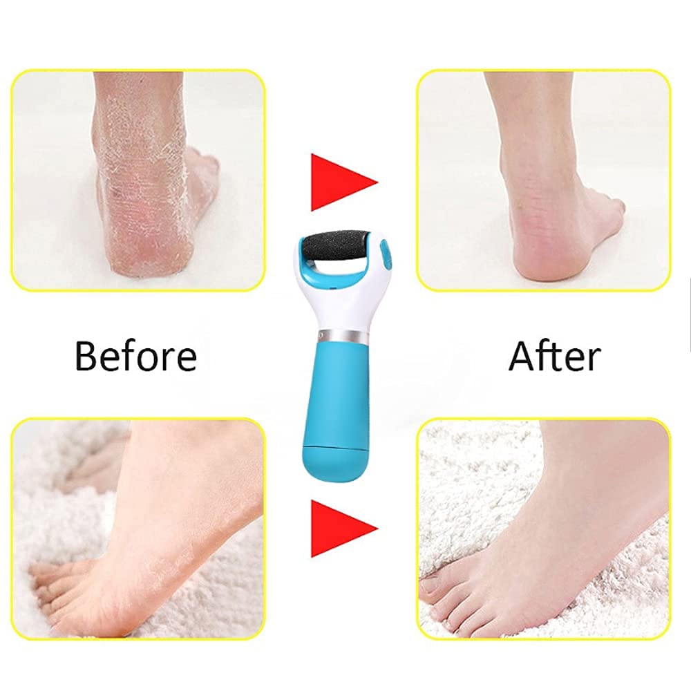 Foot Roller Callus Remover | Callus Remover Foot Scrubber Dead Skin Remover For Feet  Foot Roller Callus Remover Zaavio®