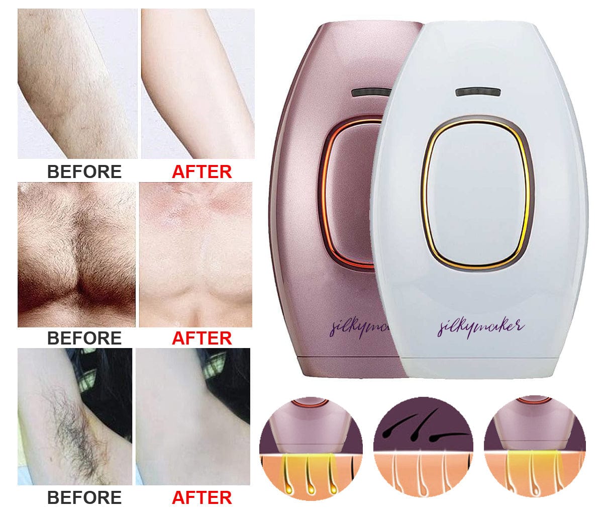 Laser Hair Removal At Home Painless Device Portable - Optixer Epilators Optixer™ Zaavio®