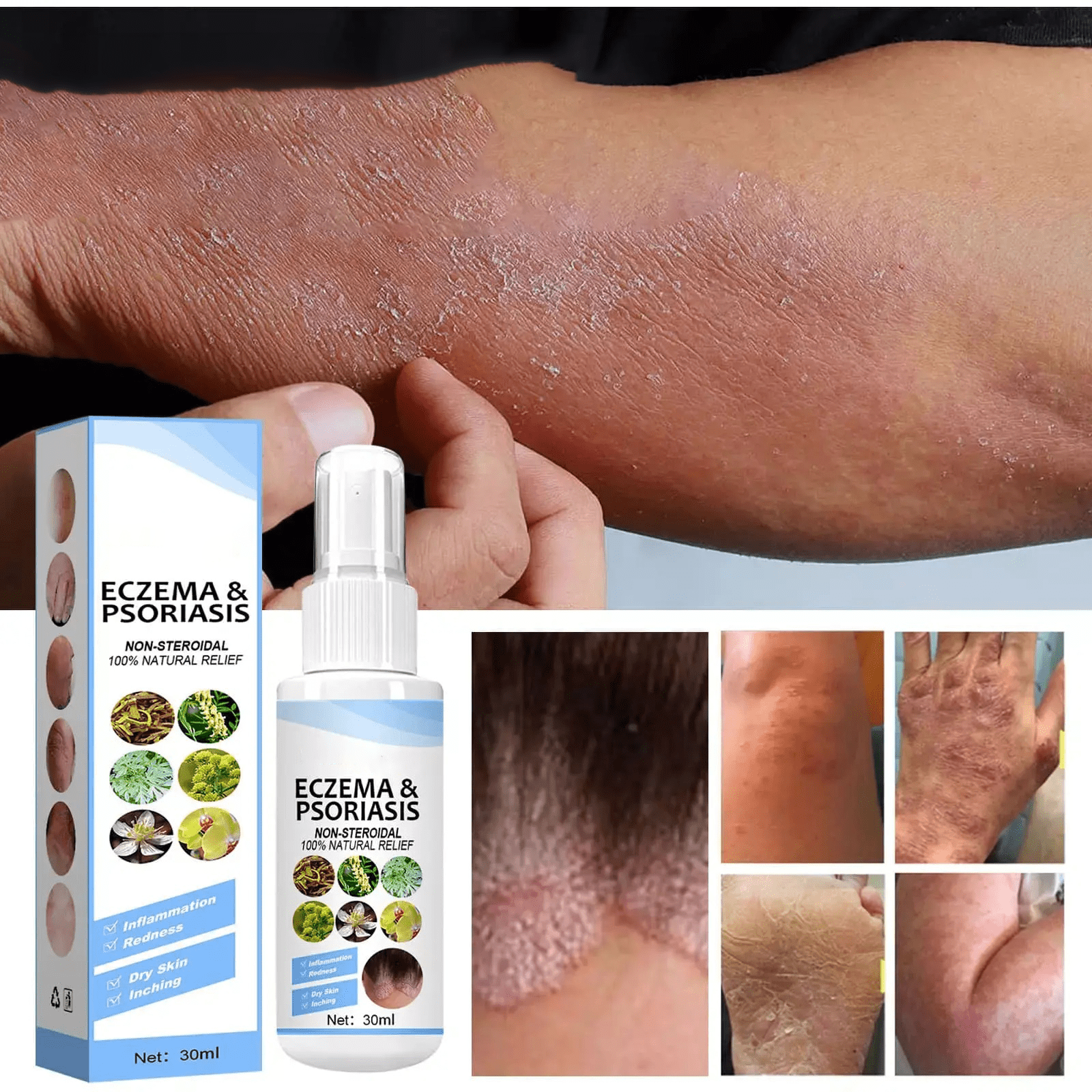 Psoriasis Treatment Vitiligo And Eczema Treatment Psoriasis Skin - PsoriHerb™️ PsoriHerb™️ Zaavio®️