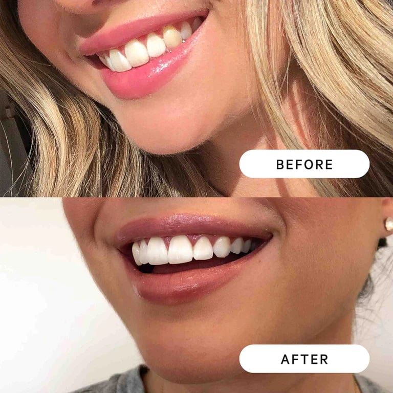 Teeth Whitening Pen Marker Whitening Products Instant Gel Treatment - Dentipen™️ Dentipen™️ Zaavio®