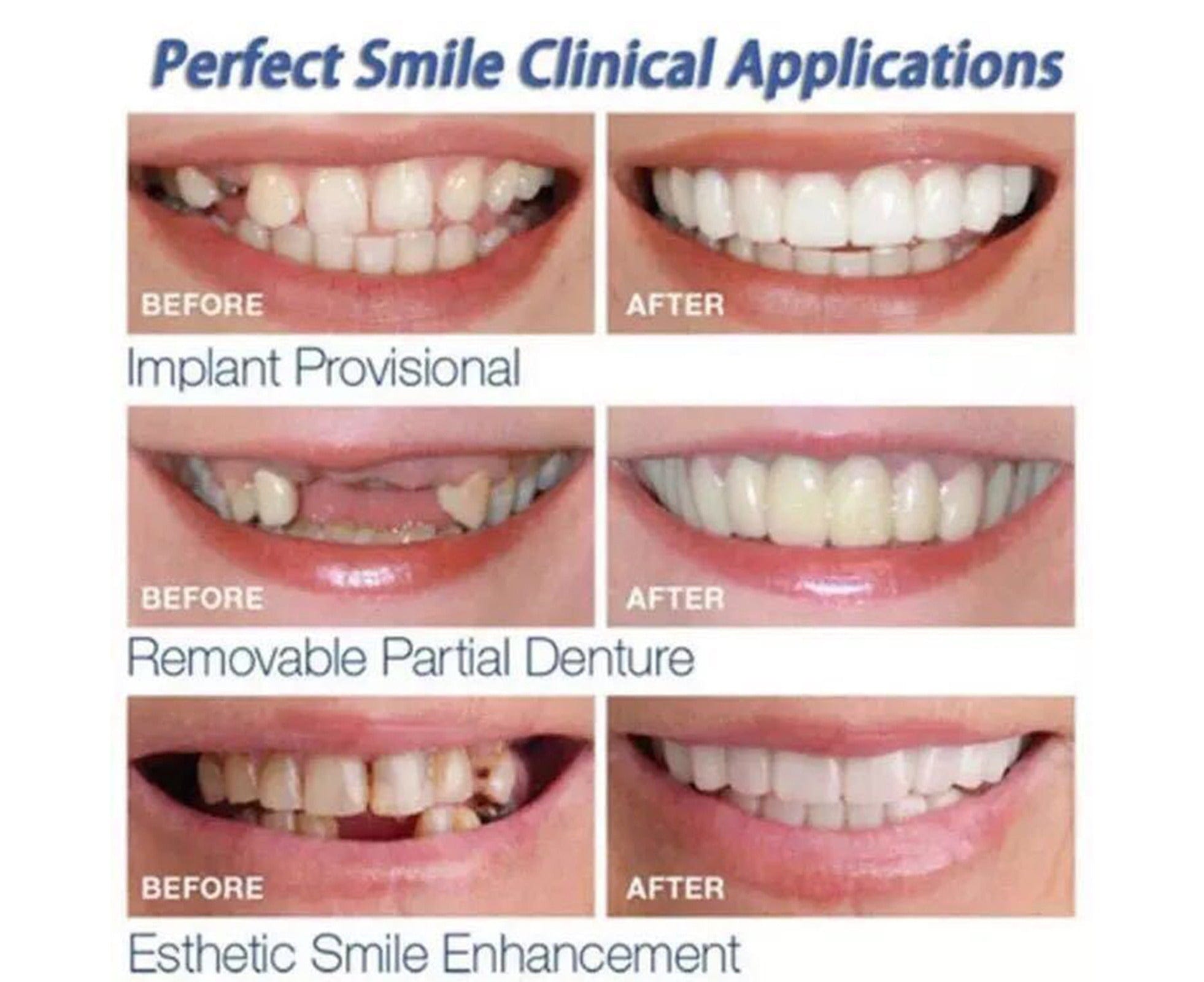 White Teeth Braces Clip On Veneer Teeth Perfect Dental Braces - Ezysmyl™️ tool Ezysmyl™️ Zaavio®