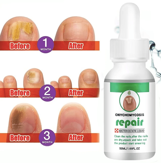 Big Bottle Nail Serum For Complete Nail Protection, Long healthy & fungus free nails Zaavio®