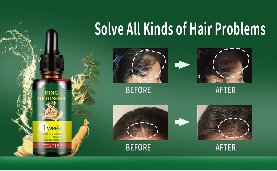 Best Hair Growth Oil Hair Fall Treatment Regrowth Serum - Exotonic™️
