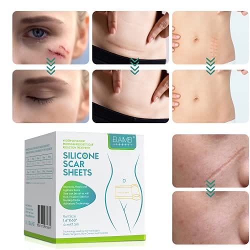Health Medical Soft Silicone Gel Tape for Scar Removal ELAIMEI