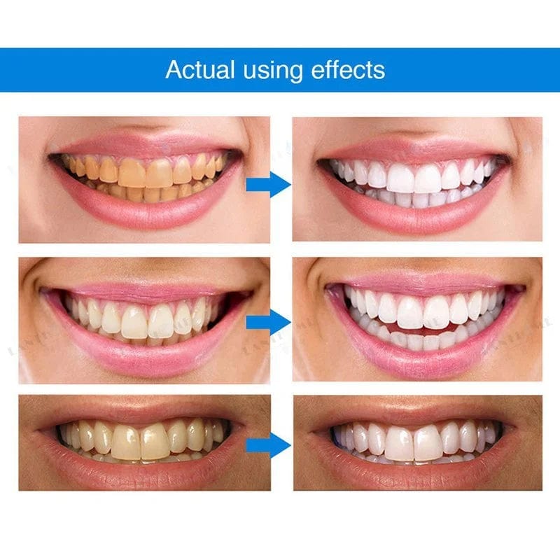 Teeth Whitening Pens WishfulCorner